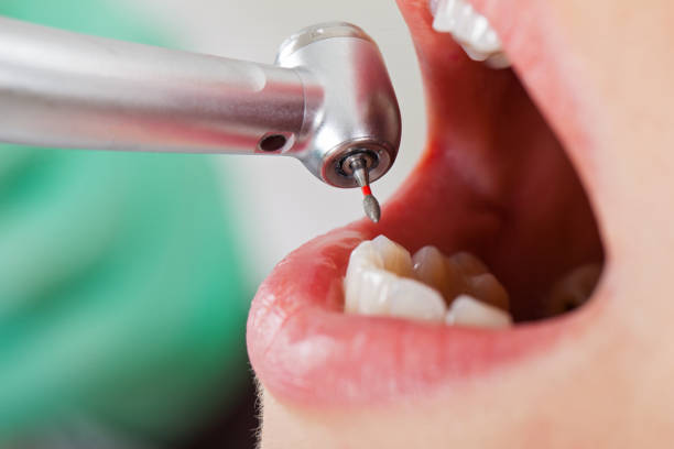 Best Emergency Dental Care for Broken or Chipped Teeth in Cedar Heights, MD